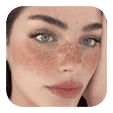 freckles